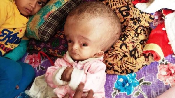 বরিশালে বড় মাথার শিশুকে নিয়ে উদ্বেগে বাবা