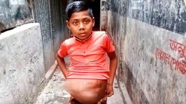 নিজের ওজনের দ্বিগুণ টিউমার নিয়ে কাটছে কাওছারের জীবন